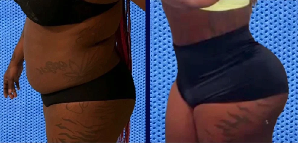 Real patient before and after body contouring, back view
