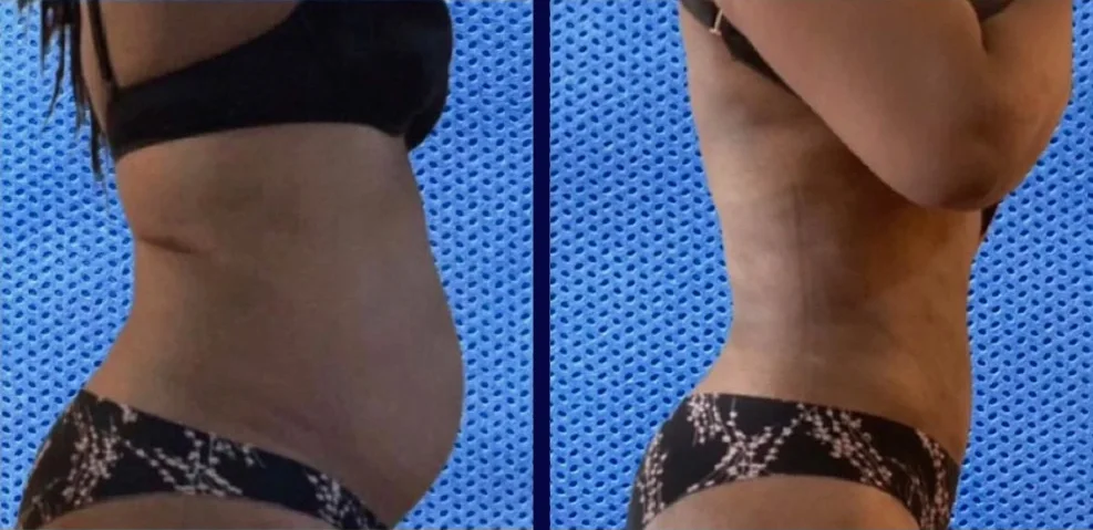 Real patient before and after liposuction, side view