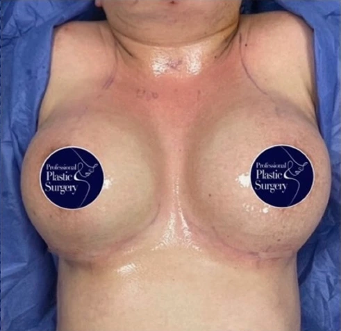 breast-aug-after-1