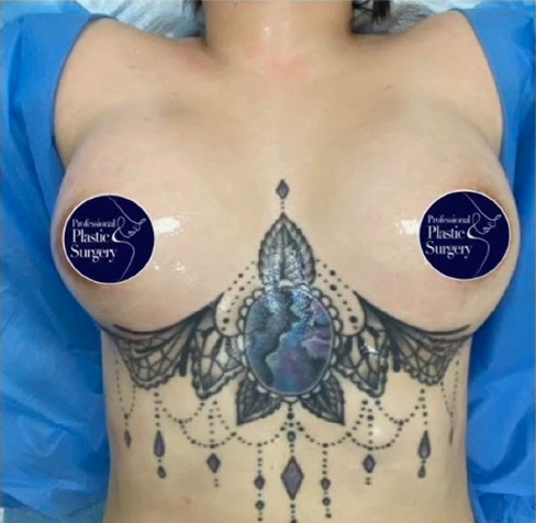 breast-aug-after-3