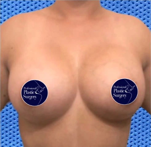 breast-aug-after-4