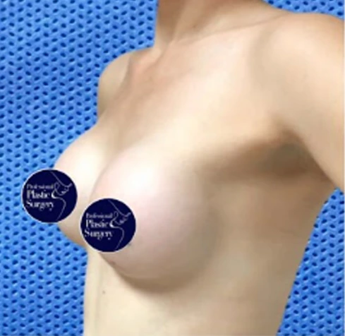 breast-aug-after-6