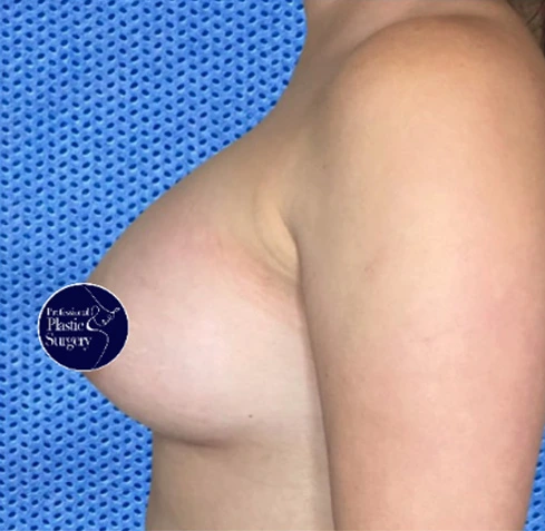 breast-aug-after-7