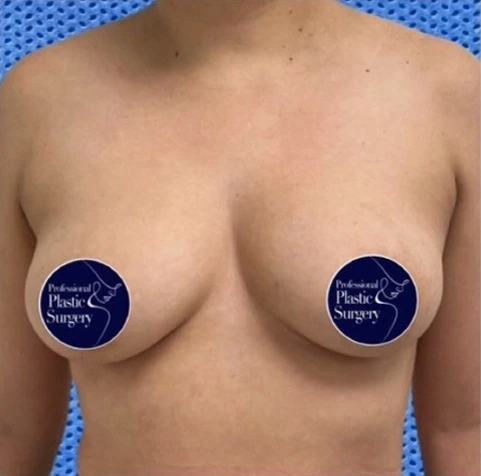 breast-aug-before-1