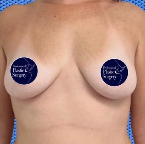 breast-aug-before-2