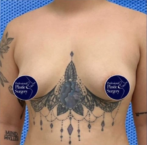 breast-aug-before-3