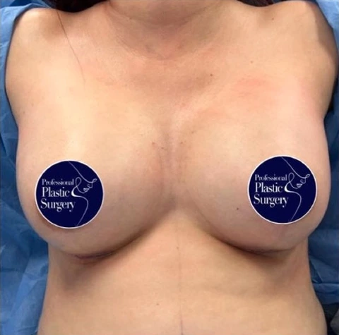 breast-aug-before-4