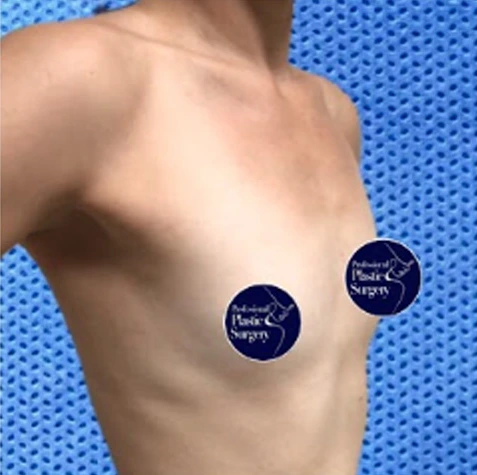 breast-aug-before-5