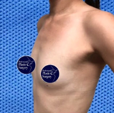 breast-aug-before-6