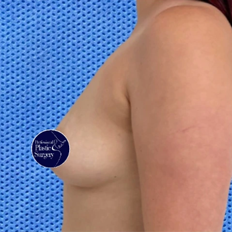 breast-aug-before-7