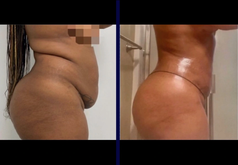 Female-Lipo-1.webp