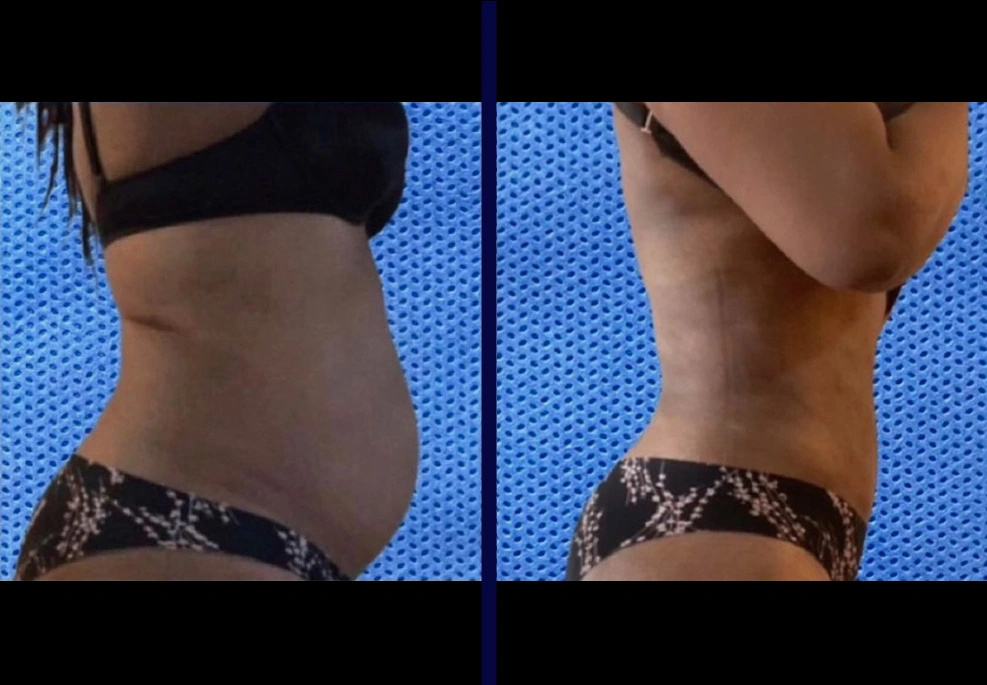 Female-Lipo-2.webp