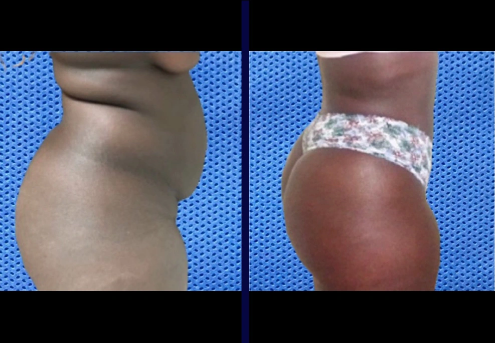 Female-Lipo-3.webp