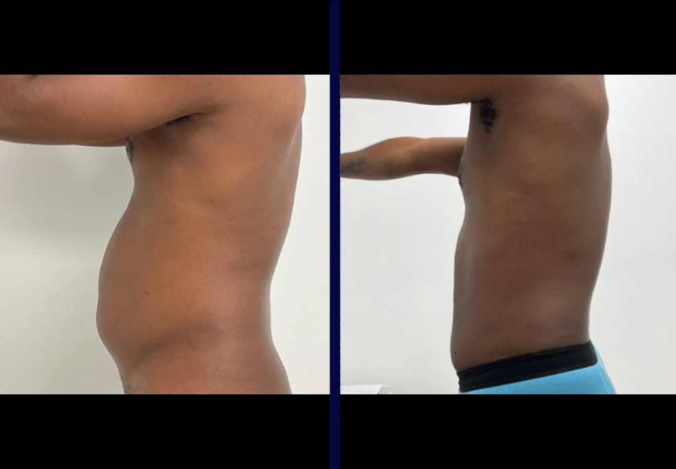 Male-lipo.webp